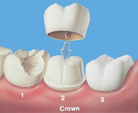 Cary Dental Crown